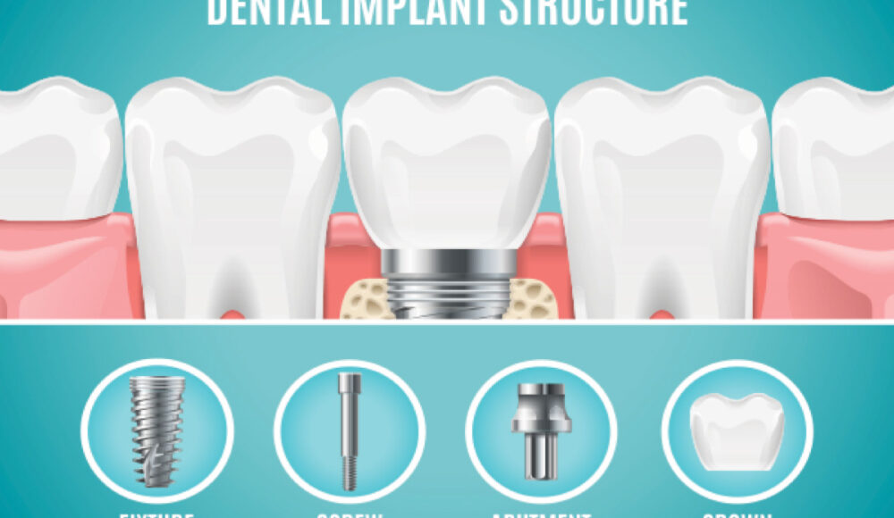 What is the dental implant process ?