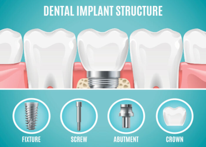 What is the dental implant process ?